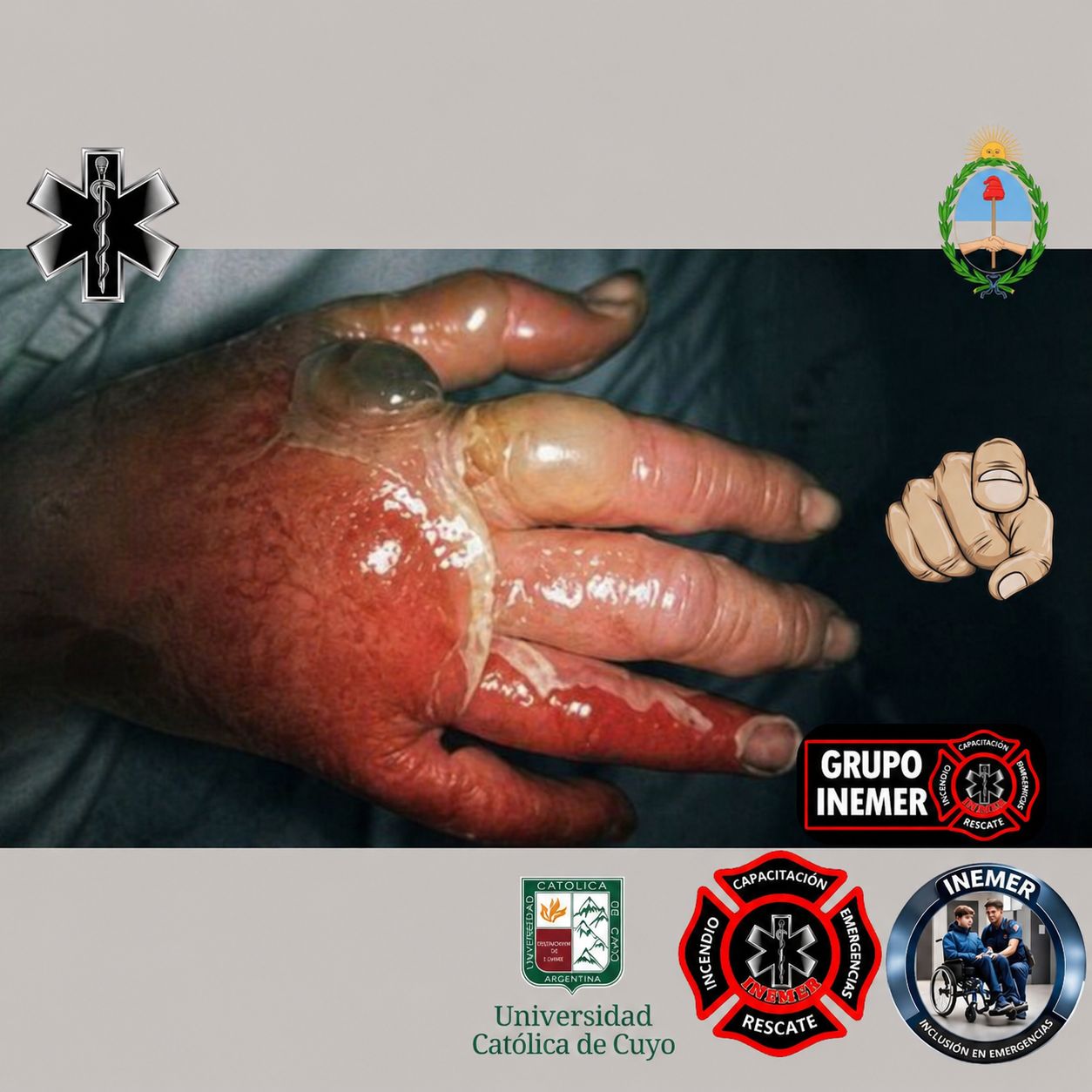 Tratamiento de Quemaduras: Cada Segundo Cuenta — Sabé Qué Hacer Antes de que Llegue la Ambulancia